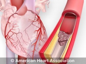 Clogged artery